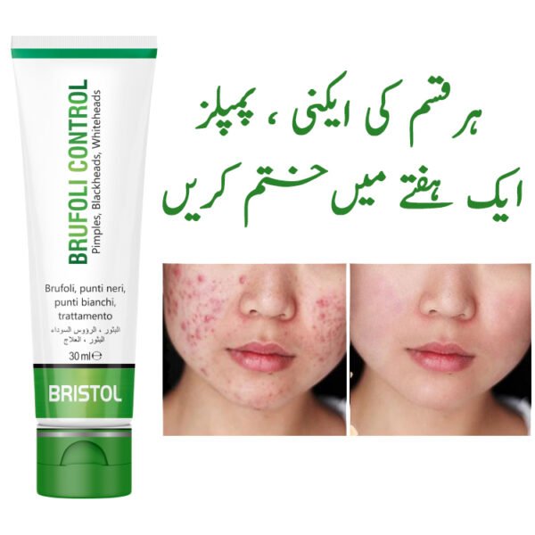 Anti Acne 3