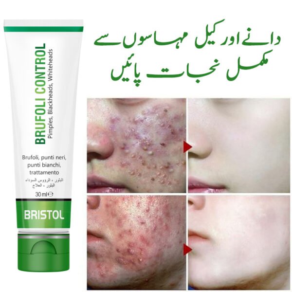 Anti Acne 4